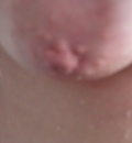 bradavky